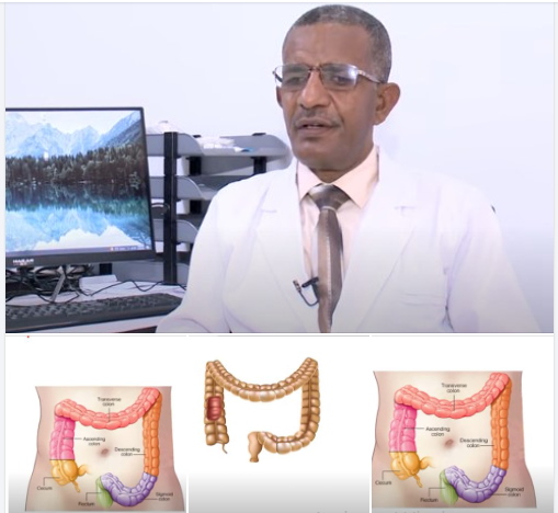 Read more about the article የአንጀት ካንሰር ህመም እና መከላከያው