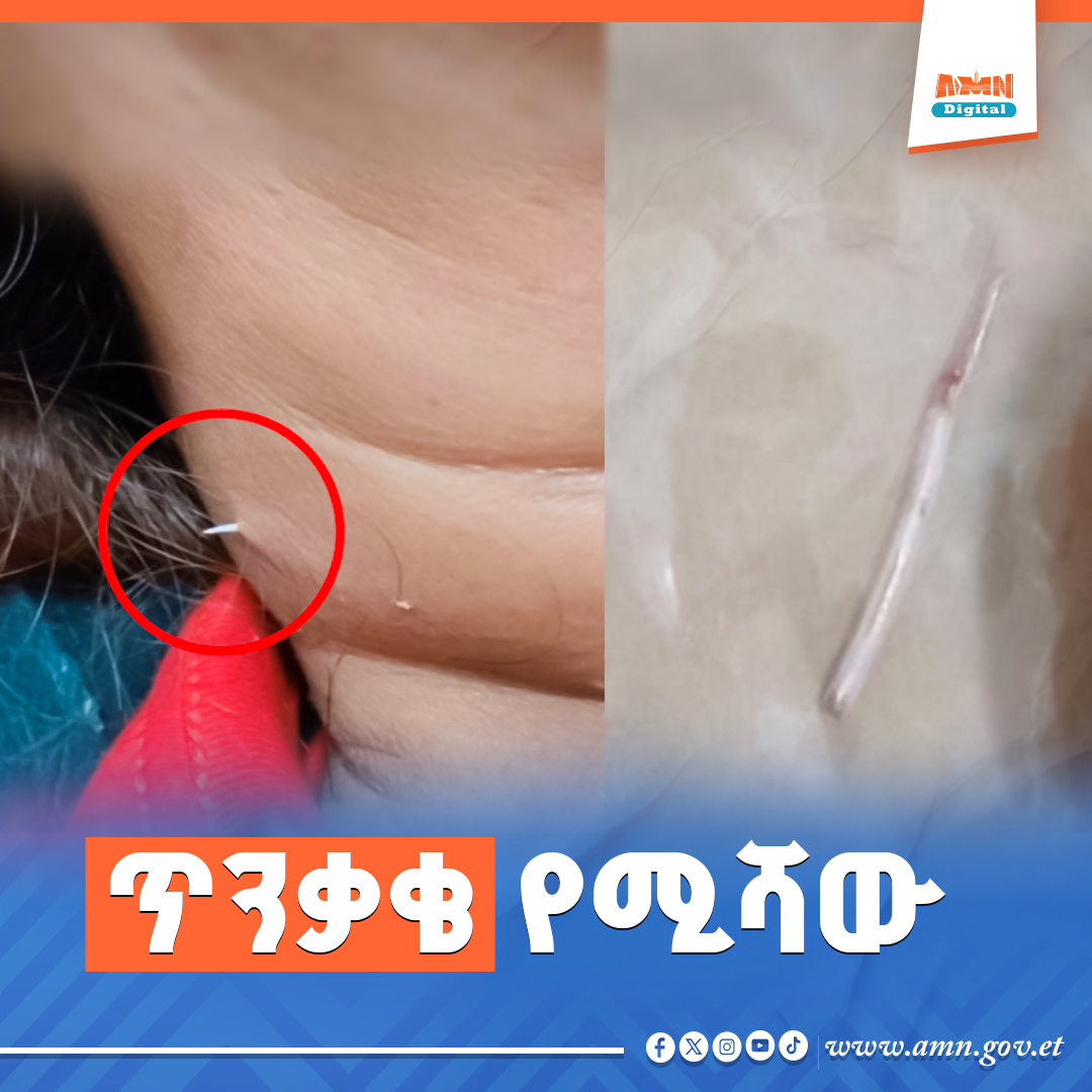 Read more about the article የታይላንዳዊቷን አንገት ወግቶ የወጣው የዓሳ አጥንት