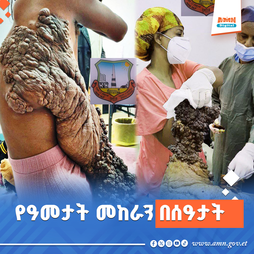 You are currently viewing የአስራ ሦስት ዓመት መከራን በአራት ሰዓታት የቀዶ ህክምና የተገላገለችው ሐዊ