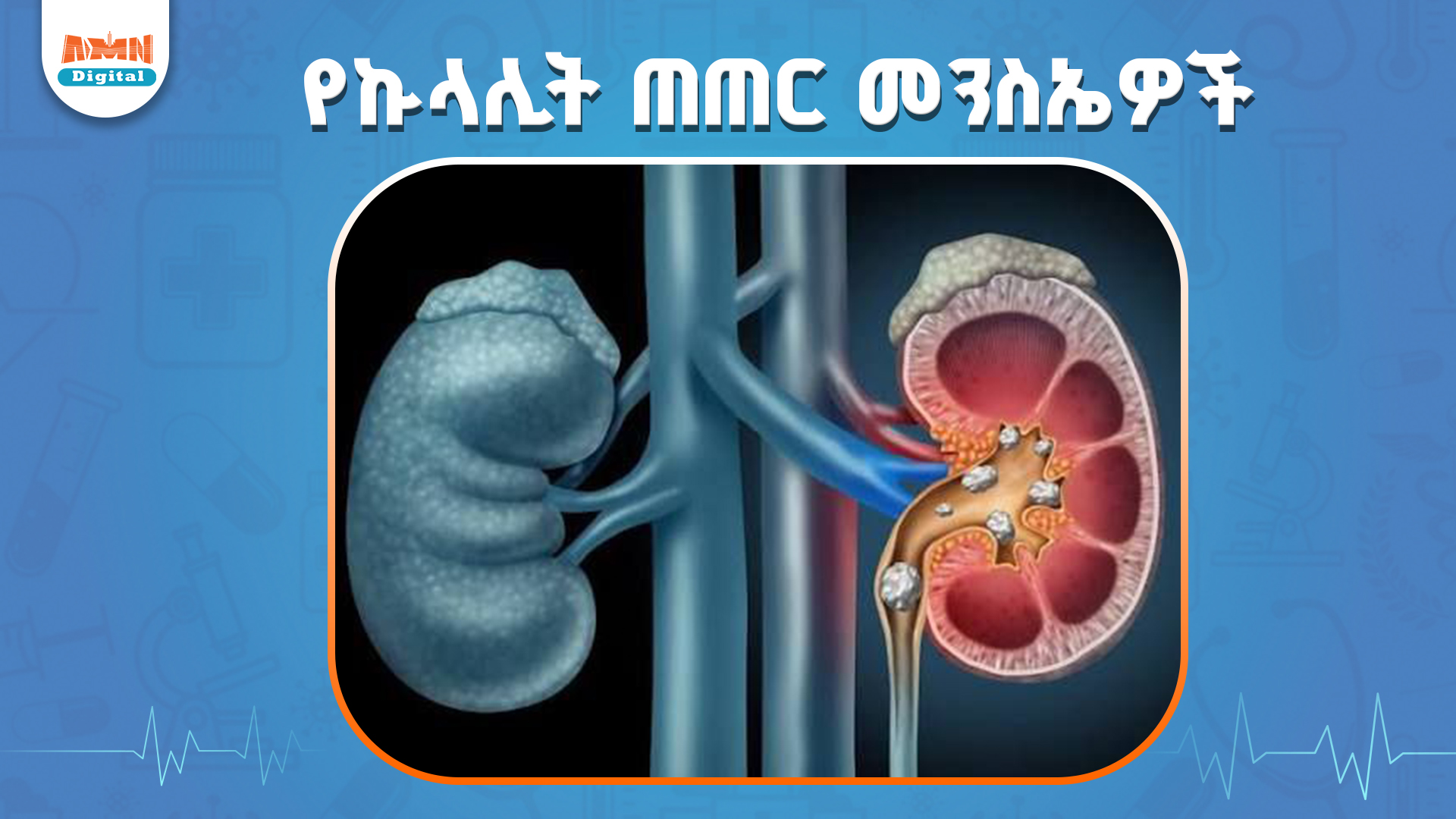 You are currently viewing የአለምን 15 በመቶ ህዝብ የሚያጠቃው ኩላሊት ጠጠር መንስዔ፣ ምልክት እና መከላከያ መንገዶች