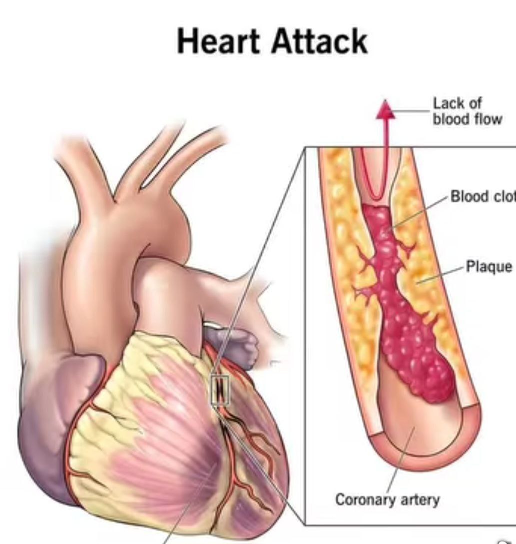 You are currently viewing የልብ እና የደም ቧንቧ በሽታ እንዴት ይከሰታል? ህክምናውስ ?