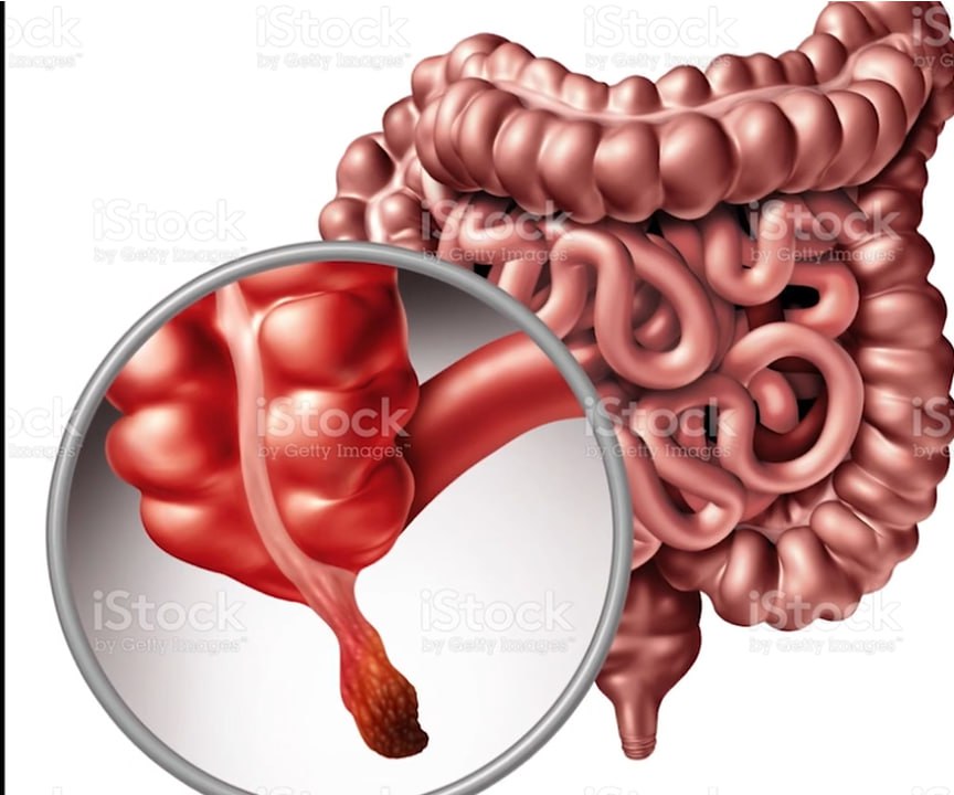 You are currently viewing የትርፍ አንጀት በሽታ