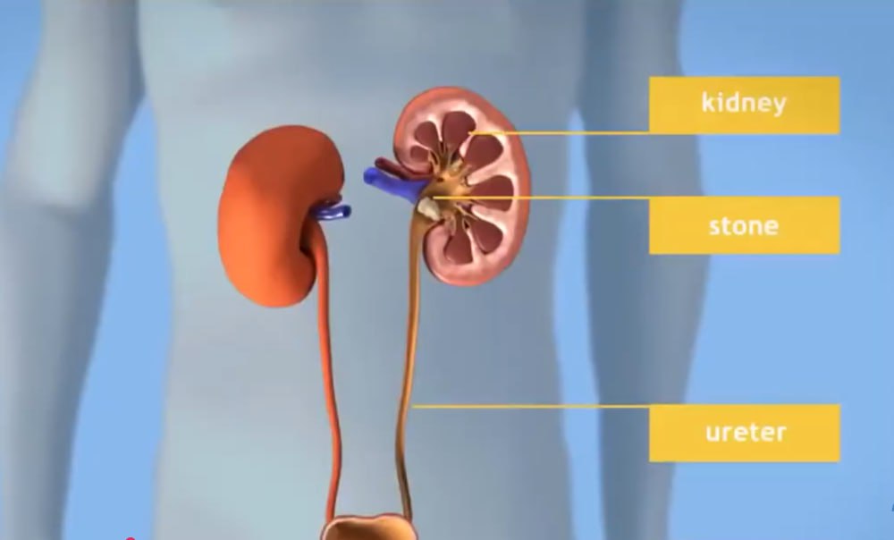 You are currently viewing የኩላሊት መዘጋት ህመም እንዴት ይከሰታል? ህመሙንስ እንዴት መከላከልይቻላል?