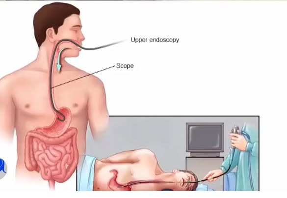 You are currently viewing የጨጓራ ካንሰር መንስኤ ምንድነዉ? ምልክቱና እና ህክምናውስ?