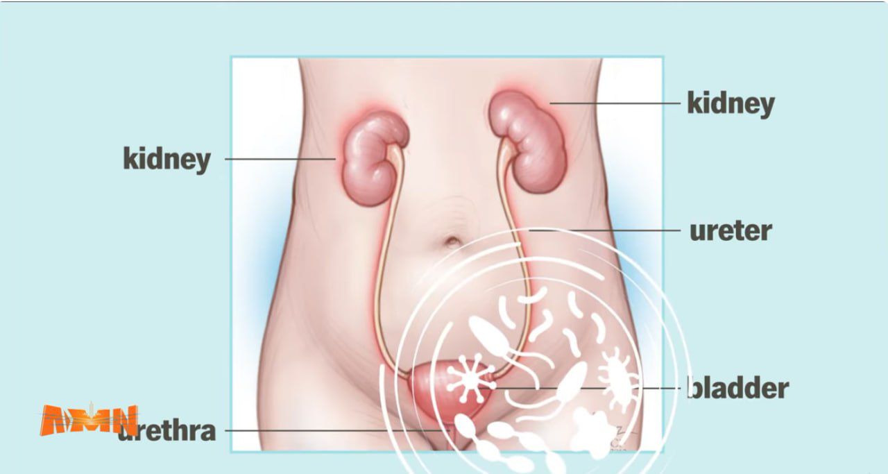 You are currently viewing የሽንት ቧንቧ ኢንፌክሽን መንስዔ፣ መከላከያ እና ሕክምና
