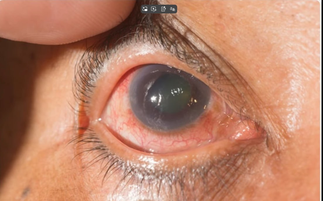 You are currently viewing ስለ ግላኮማ ወይም የዓይን ግፊት በሽታ ምን ያህል ያውቃሉ ? ሕክምናውስ ?