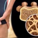 Read more about the article የአጥንት ቲቢ በሽታ ምንድነዉ?