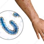 Read more about the article ማርበርግ ቫይረስ ተስፋፍቶ የከፋ ጉዳት እንዳያስከትልና ወረርሽኙን ለመቆጣጠር እየተሠራ ነው