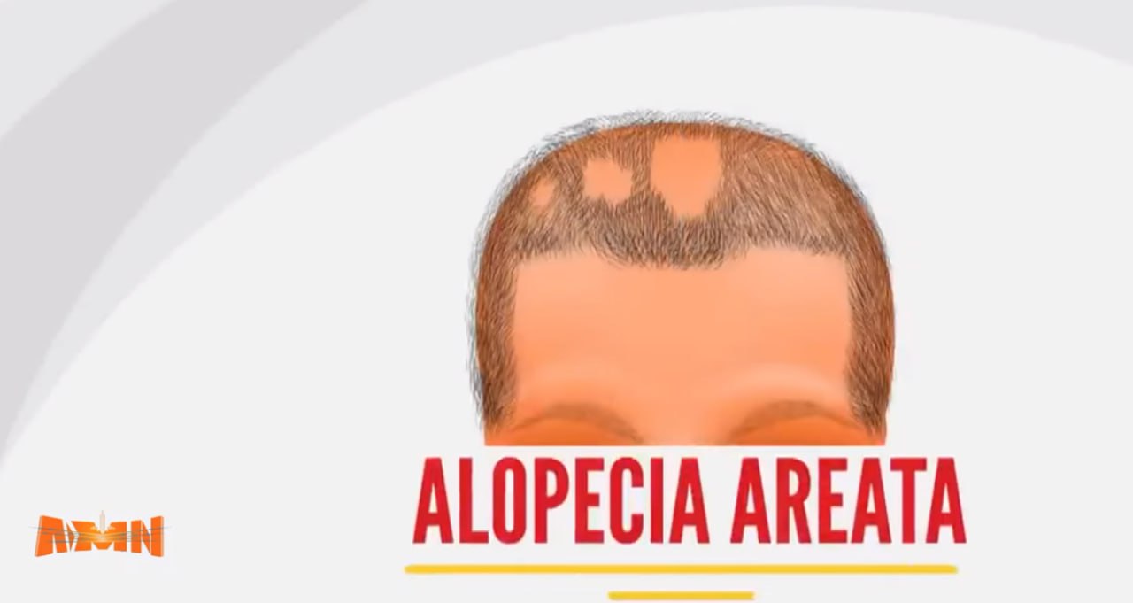 You are currently viewing የላሽ በሽታ (Alopecia) እንዴት ይከሰታል? መፍትሔውስ?