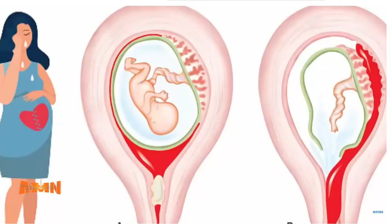 You are currently viewing የፅንስ መቋረጥ እንዴት ይከሰታል?