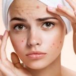 Read more about the article የብጉር ጠባሳን ከማከም ብጉሩን ራሱን ቀድሞ ማከም ይቀላል