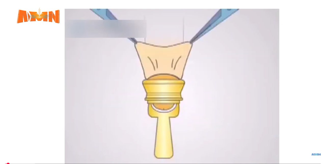 You are currently viewing የወንድ ልጅ ግርዛት፣ ለጤና ያለው ፋይዳ እና መደረግ ያለባቸው ጥንቃቄዎች