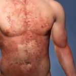 Read more about the article የቆዳ አለርጂ መንስኤዎች፣ ምልክቶች እና መወሰድ ያለባቸው ጥንቃቄዎች