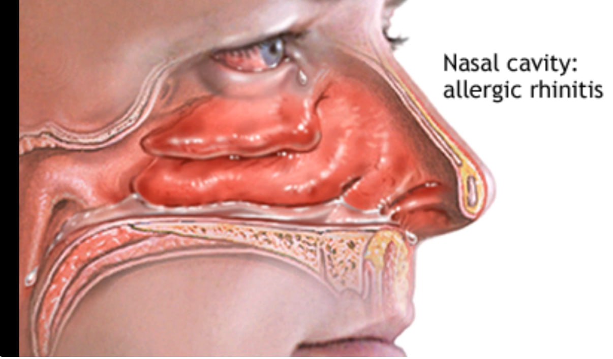 You are currently viewing የአፍንጫ አለርጂ- ከቀስቃሽ ሁኔታዎች እስከ ዘላቂ መፍትሄዎች